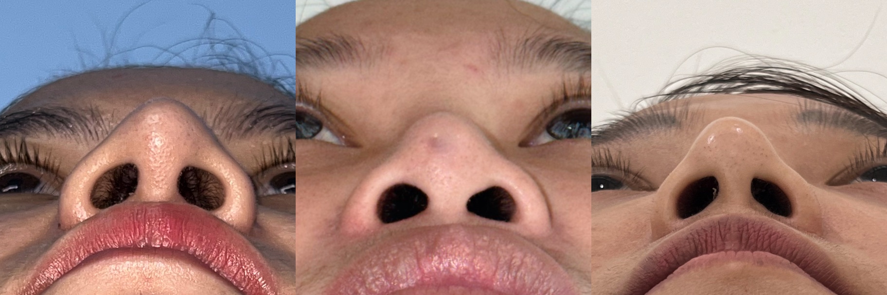 Before revision rhinoplasty examples showing tip deformity after previous rhinoplasty