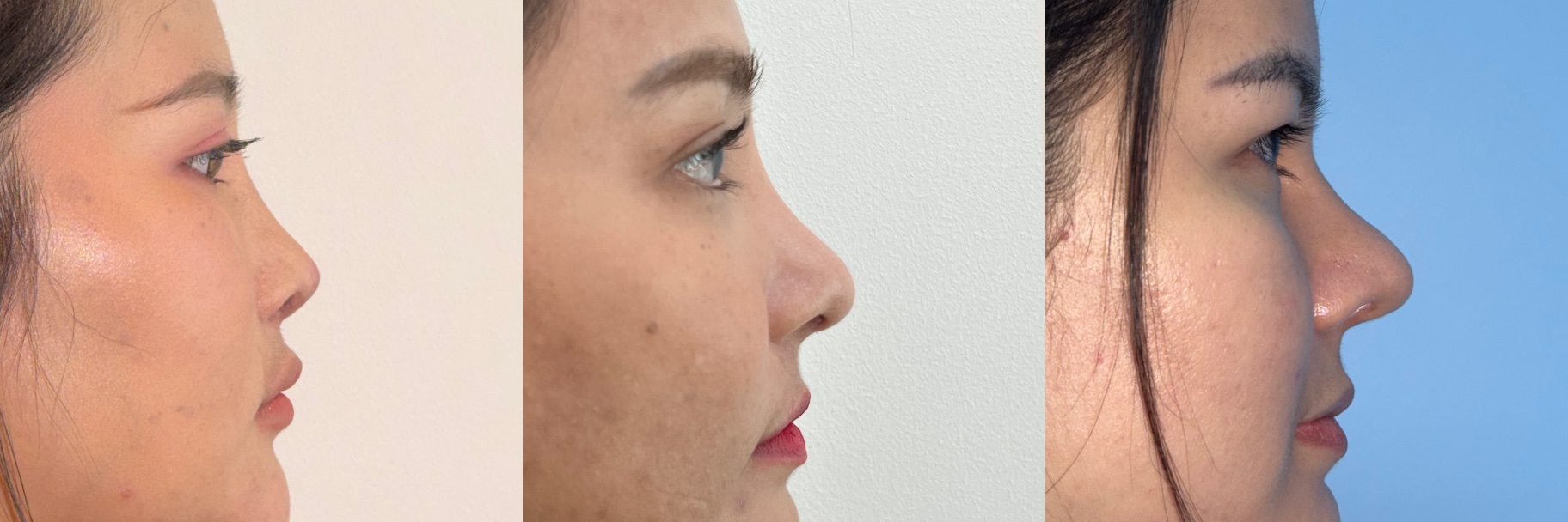 After revision rhinoplasty examples showing correction of tip malposition and high radix after previous rhinoplasty
