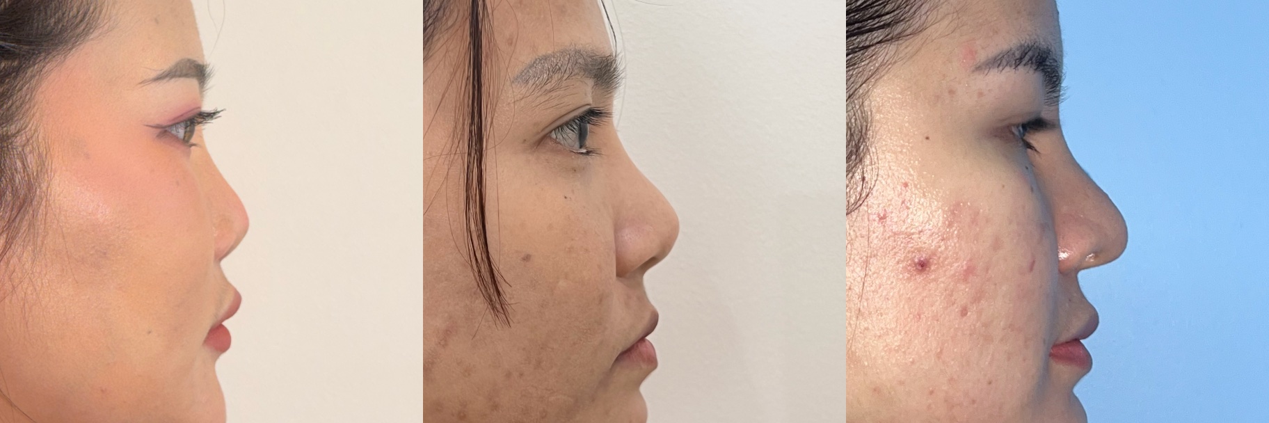 Before revision rhinoplasty examples showing tip malposition and high radix after previous rhinoplasty