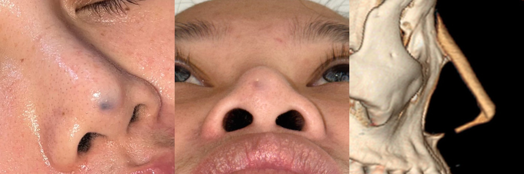 Clinical example of impending nasal implant extrusion after previous rhinoplasty