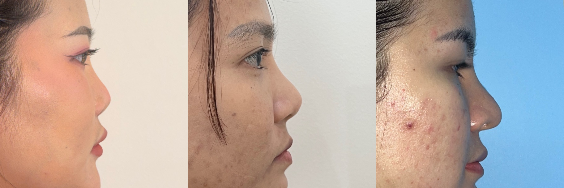 Clinical example of nasal implant malposition involving the tip and radix after previous rhinoplasty
