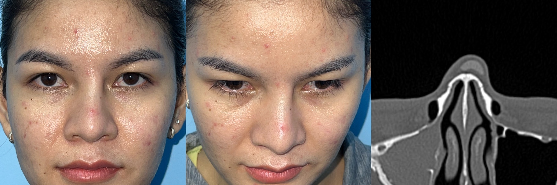 Clinical example of costal cartilage graft or implant deviation after previous rhinoplasty