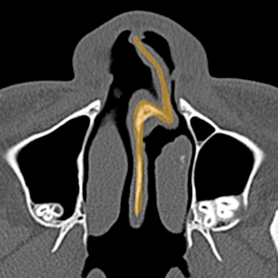 Axial CT view used during preoperative structural rhinoplasty assessment