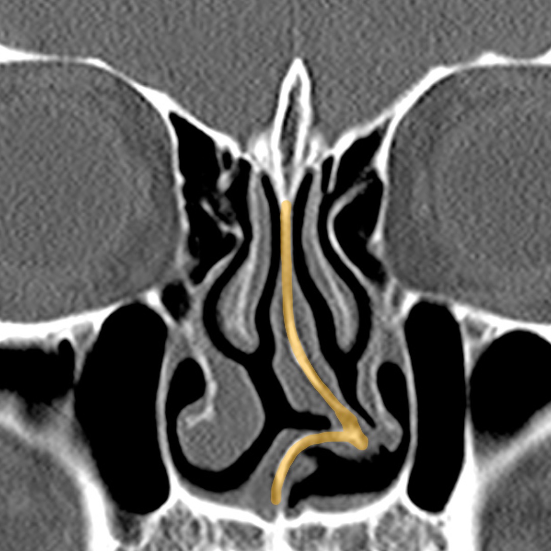 Coronal CT view used during preoperative structural rhinoplasty assessment