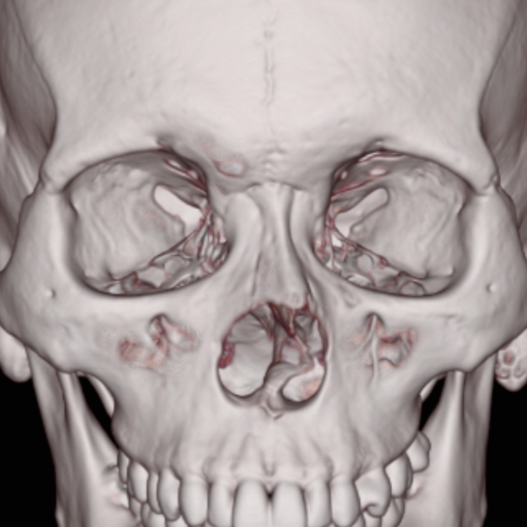 Three-dimensional CT reconstruction used during preoperative structural rhinoplasty assessment