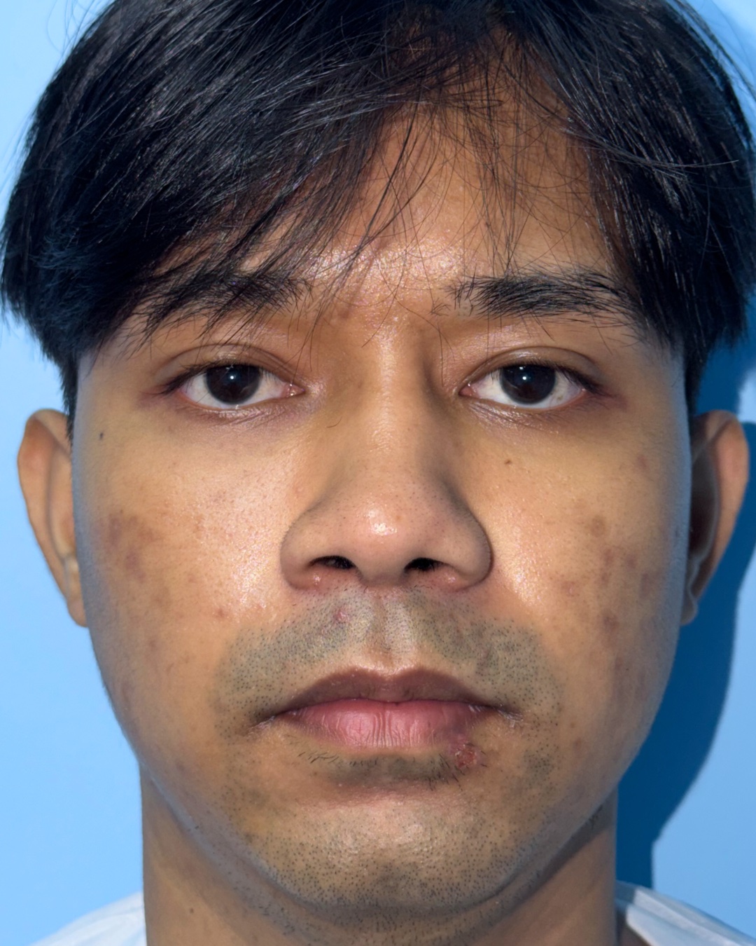 After structural and functional rhinoplasty for severe congenital nasal deviation