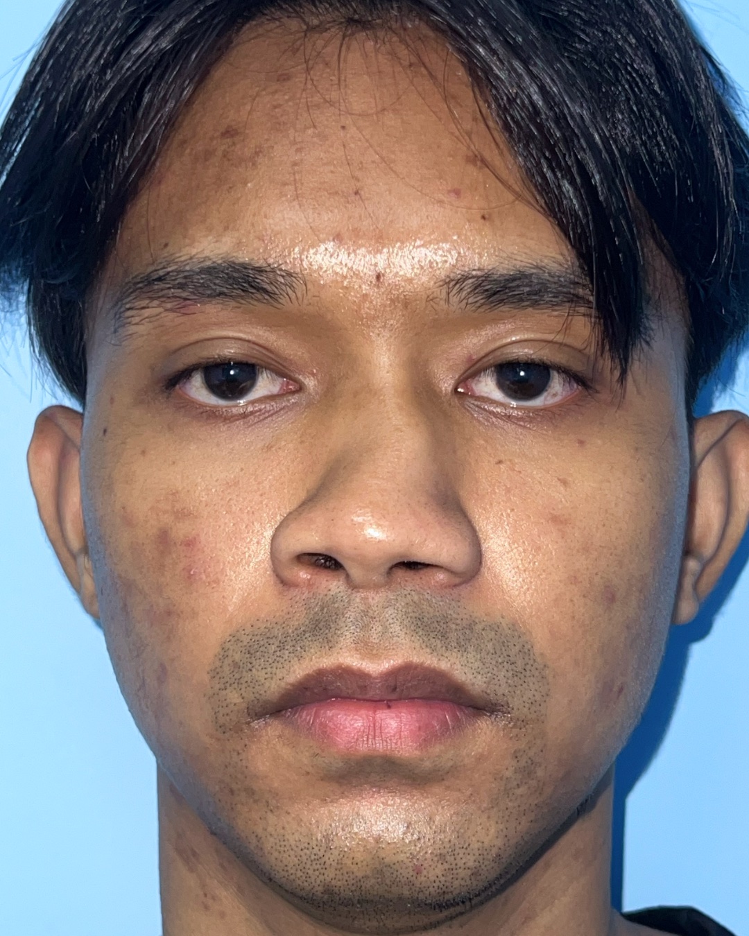 Before structural and functional rhinoplasty showing severe congenital nasal deviation