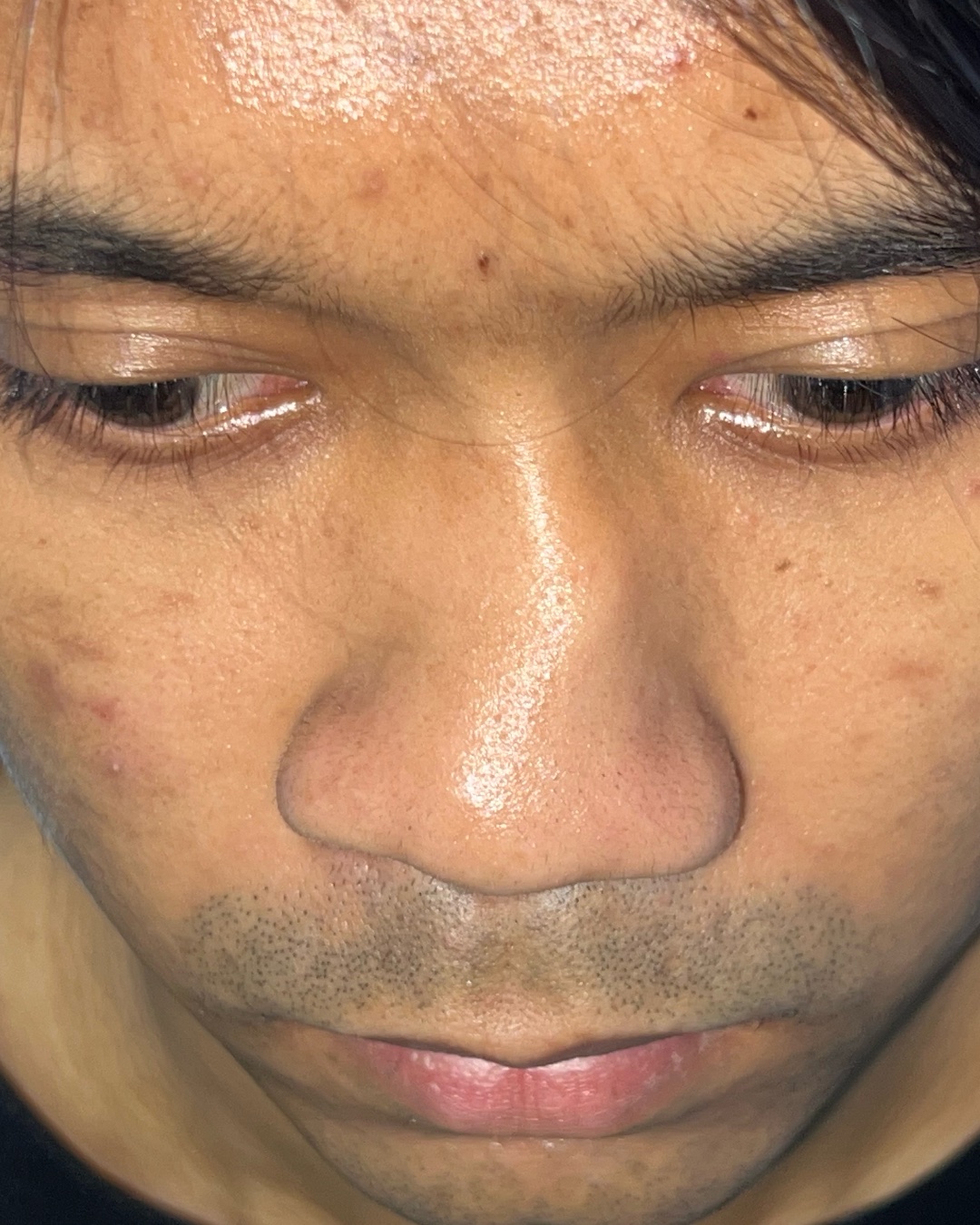 Clinical example illustrating nasal asymmetry in structural rhinoplasty assessment